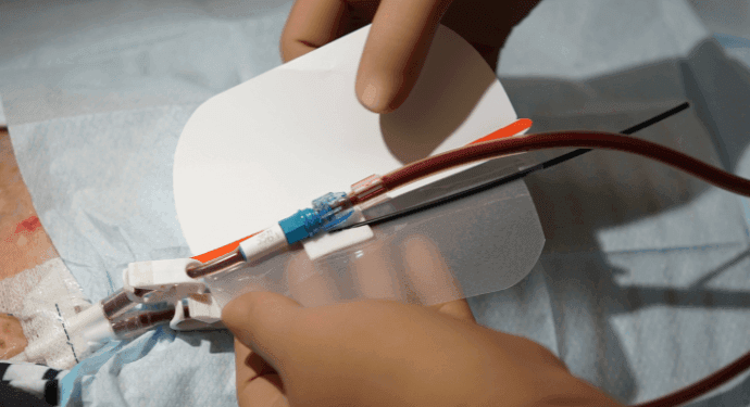 “Ett blodbad” - CBS NEWS uppmärksammar riskerna vid venös nållossning och Redsense Medicals arbete mot trygg dialysvård